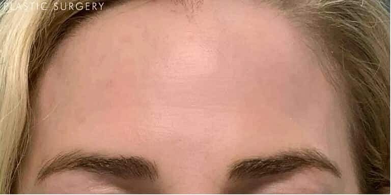 Dysport Before & After