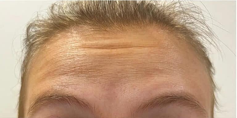 Dysport Before & After