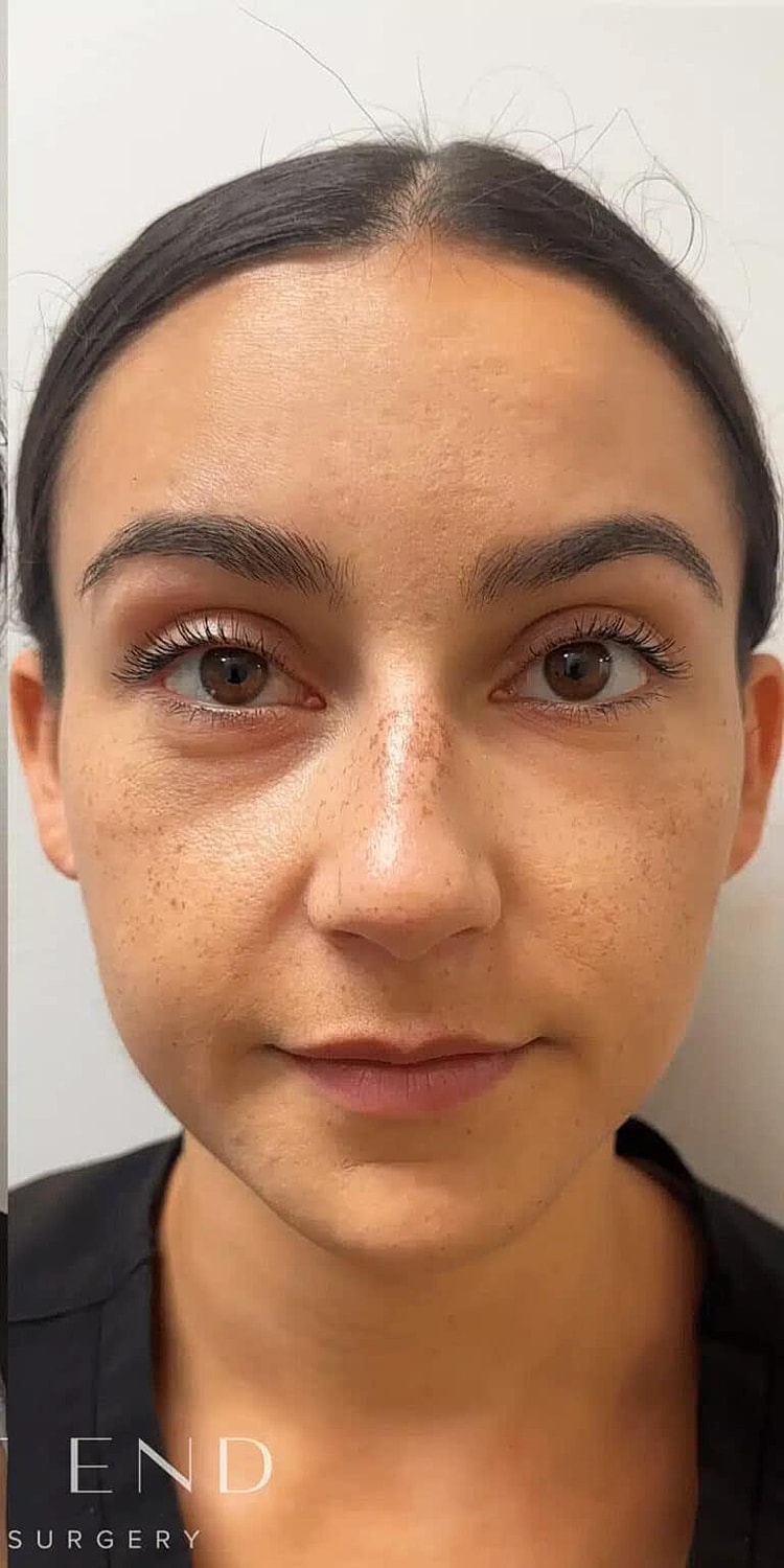 Dysport Before & After