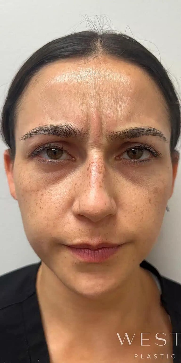 Dysport Before & After