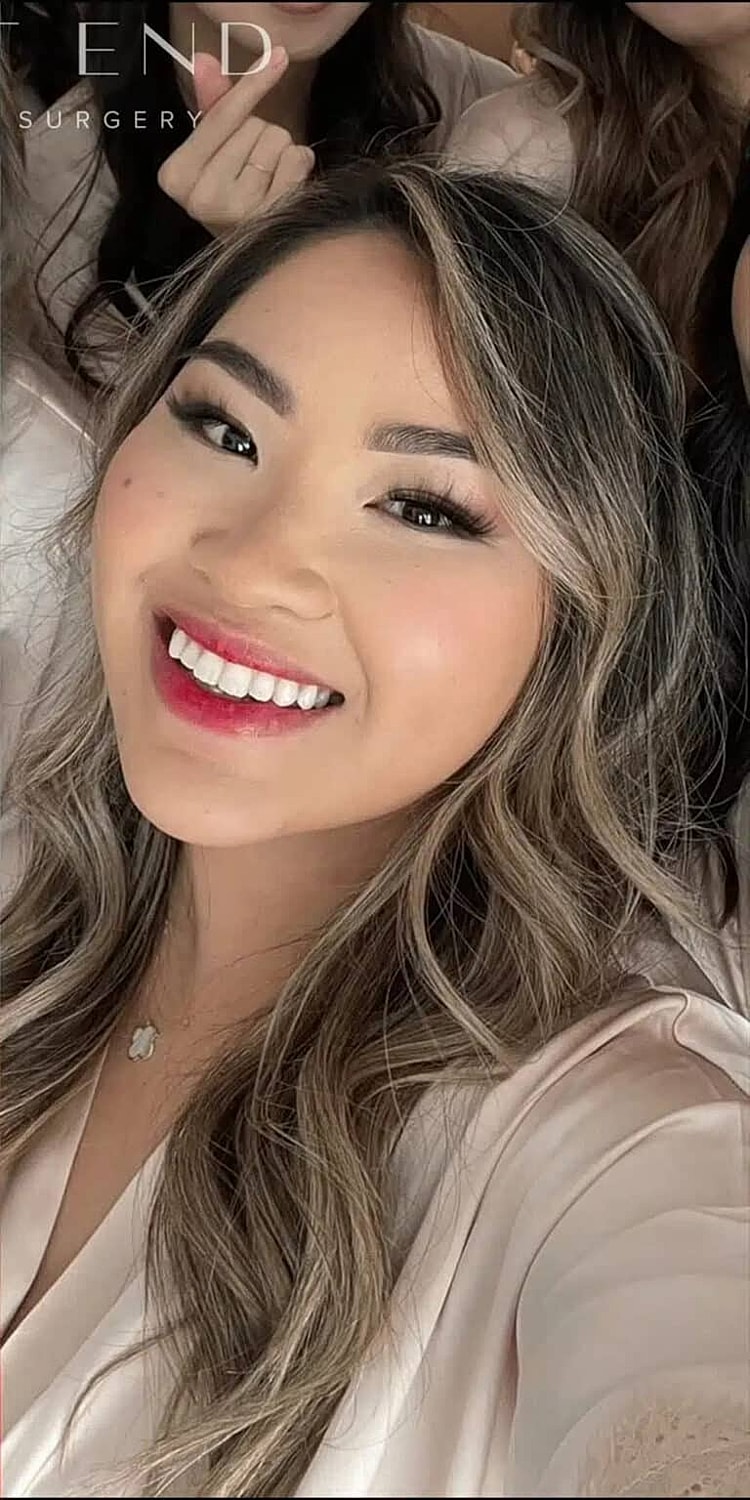 Dysport Before & After