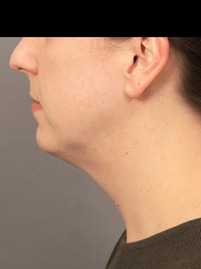 Cheek Implants Before & After