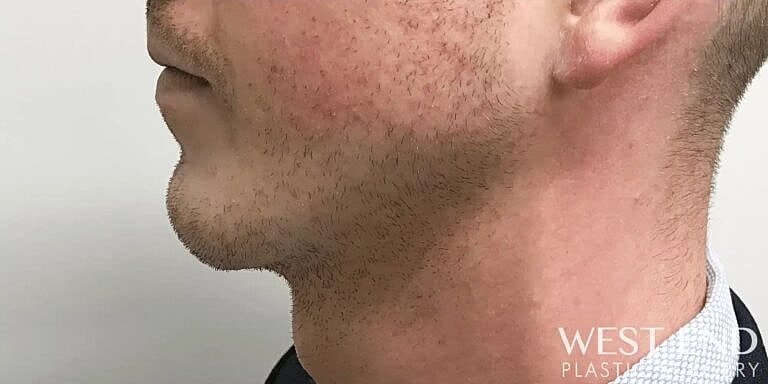 Cheek Implants Before & After