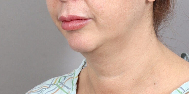 Neck Lift Before & After