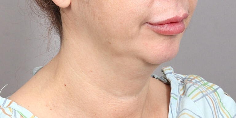 Neck Lift Before & After