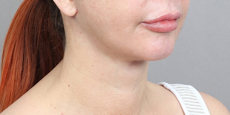 Neck Lift Before & After