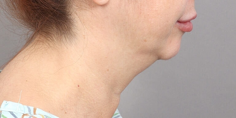 Neck Lift Before & After