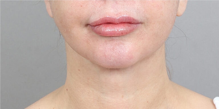 Neck Lift Before & After