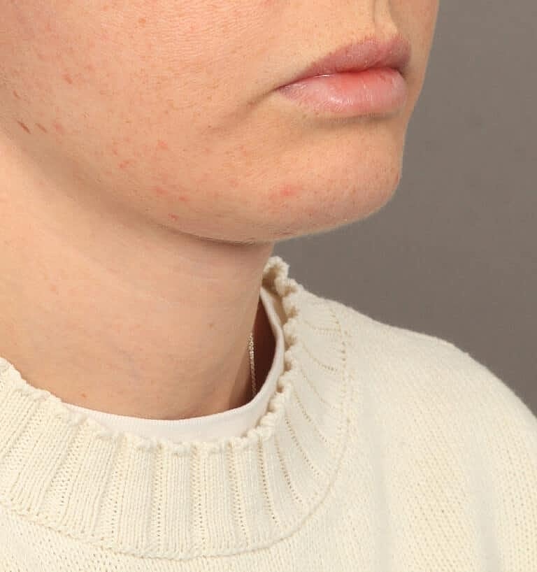 Neck Lift Before & After