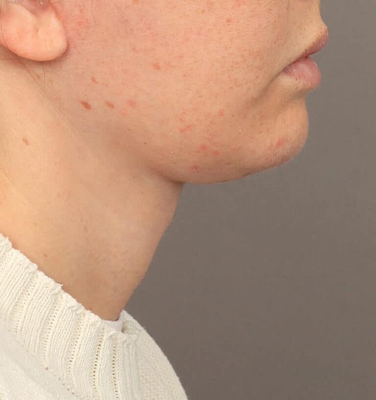 Neck Lift Before & After