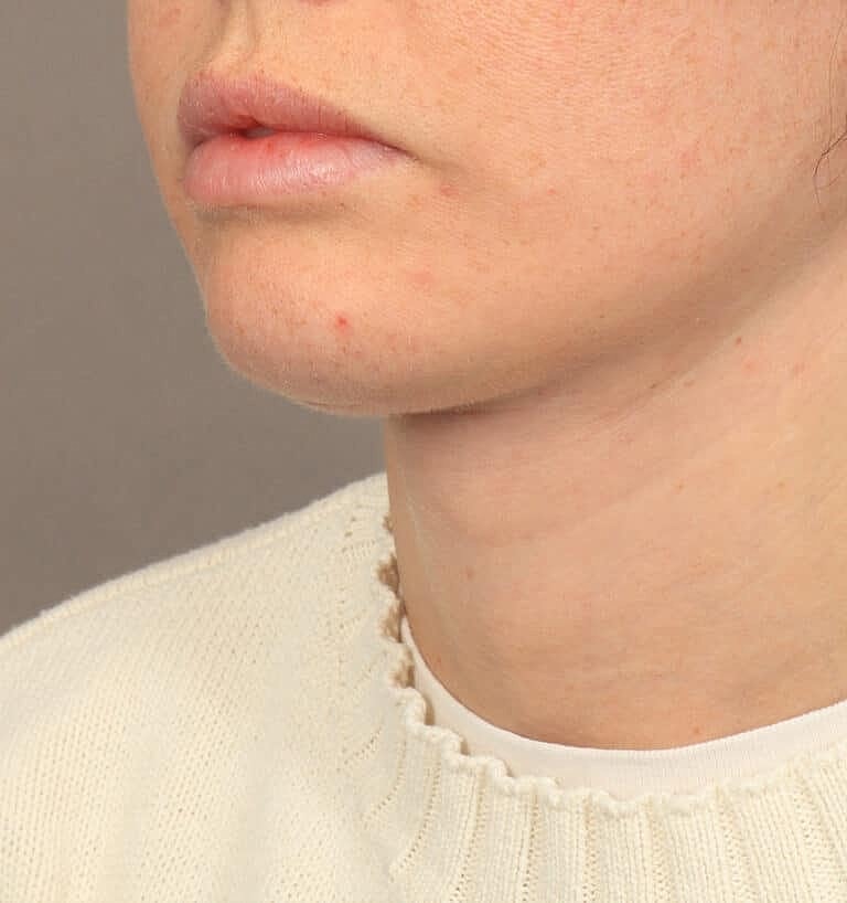 Neck Lift Before & After