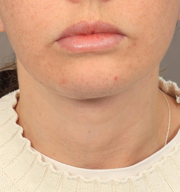 Neck Lift Before & After