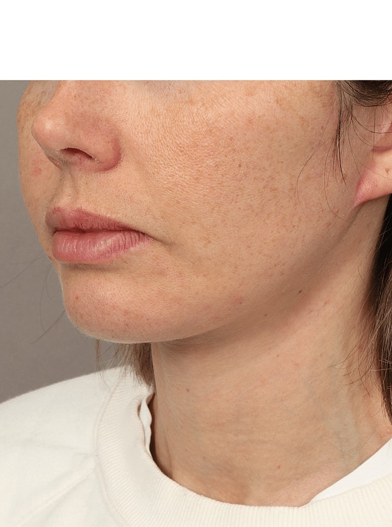 Neck Lift Before & After