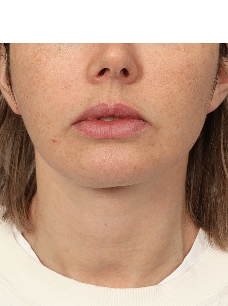 Neck Lift Before & After