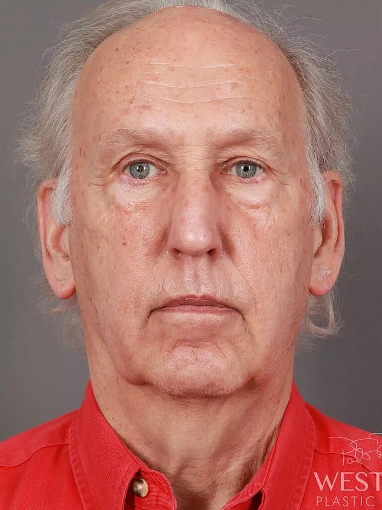 Neck Lift Before & After