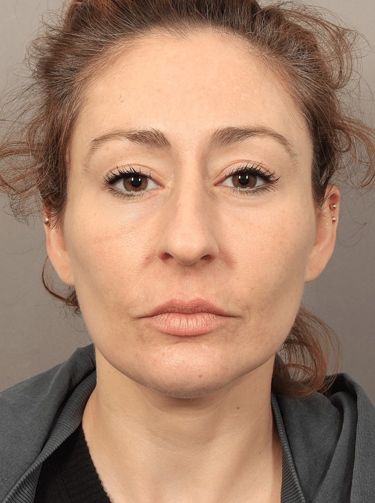 Neck Lift Before & After