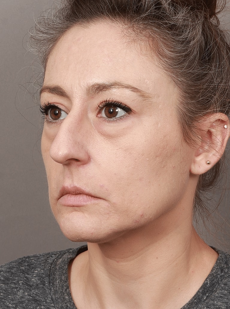 Neck Lift Before & After