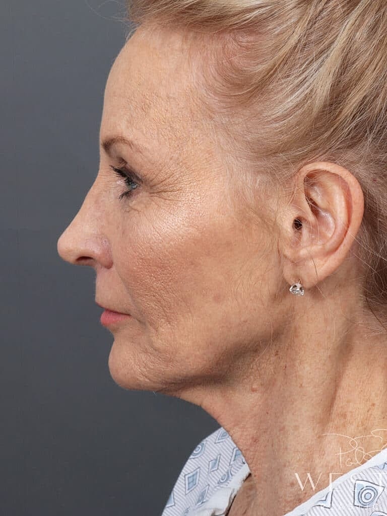 Neck Lift Before & After