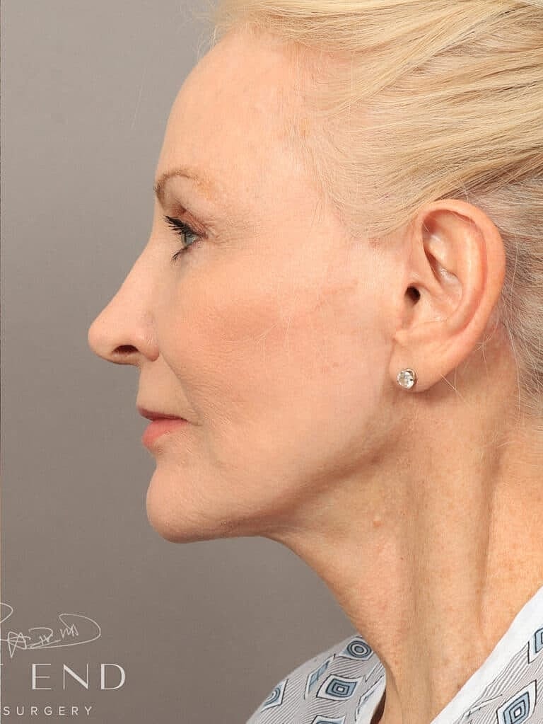 Neck Lift Before & After