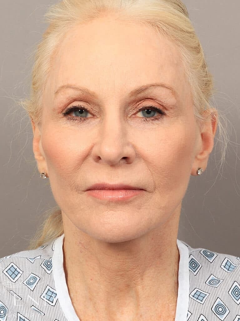 Neck Lift Before & After