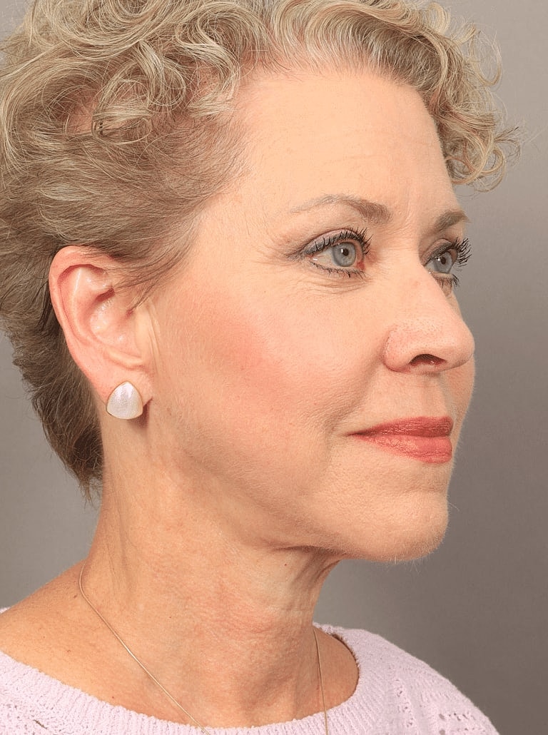 Neck Lift Before & After