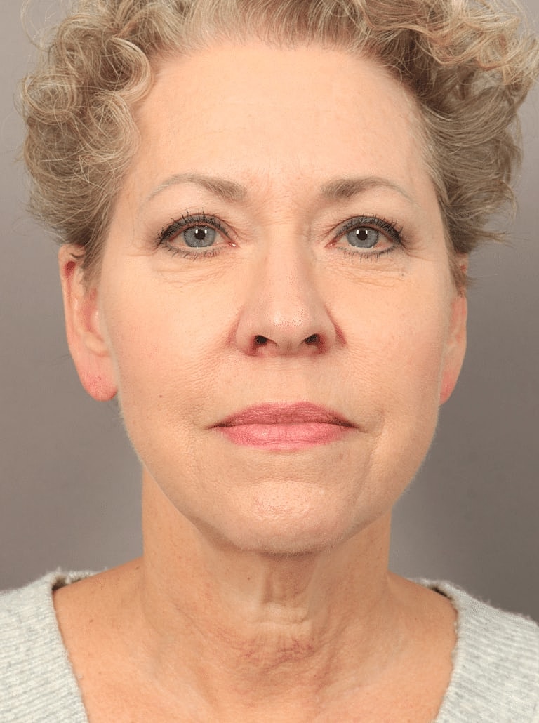 Neck Lift Before & After