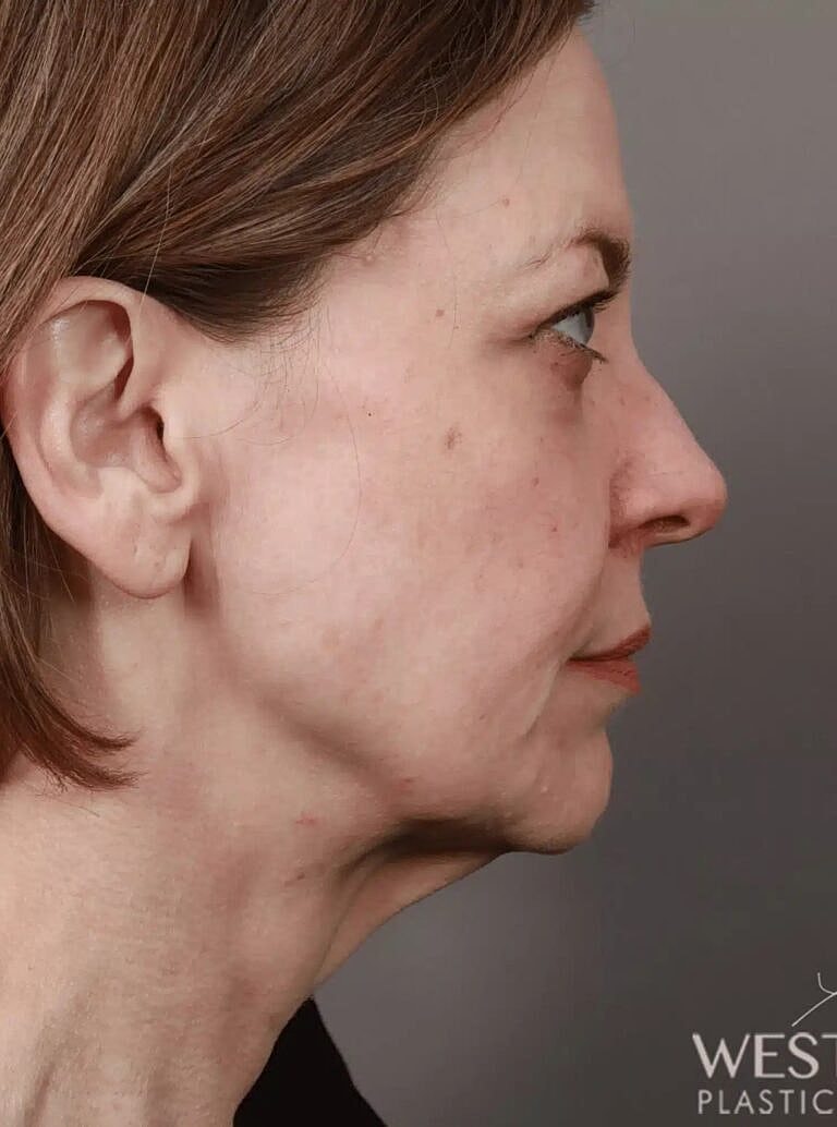 Neck Lift Before & After