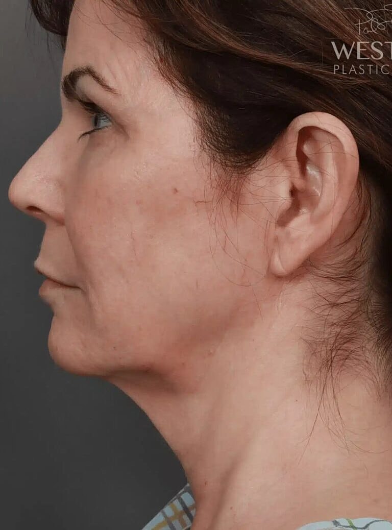 Neck Lift Before & After