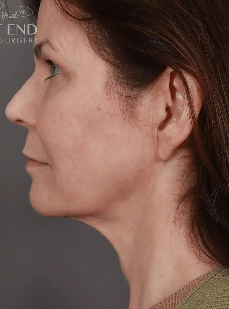 Neck Lift Before & After