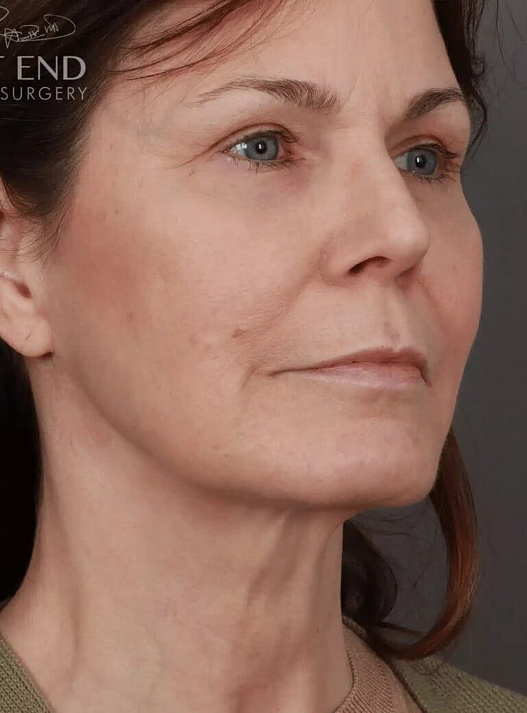 Neck Lift Before & After