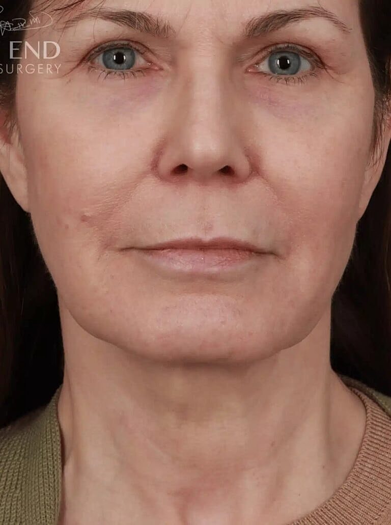 Neck Lift Before & After