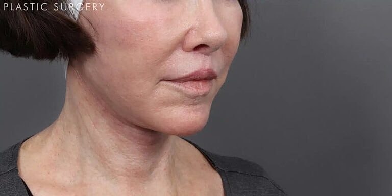 Neck Lift Before & After