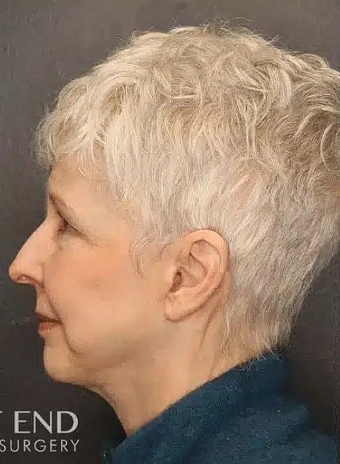 Neck Lift Before & After