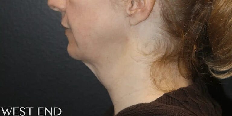 Neck Lift Before & After