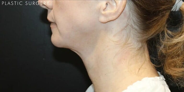 Neck Lift Before & After