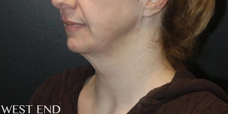 Neck Lift Before & After