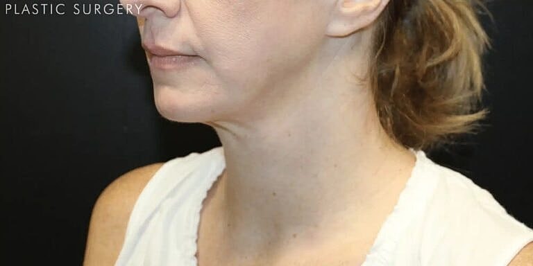 Neck Lift Before & After
