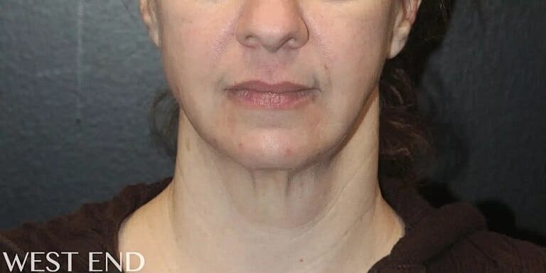 Neck Lift Before & After