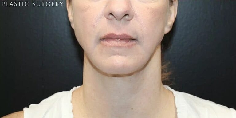 Neck Lift Before & After