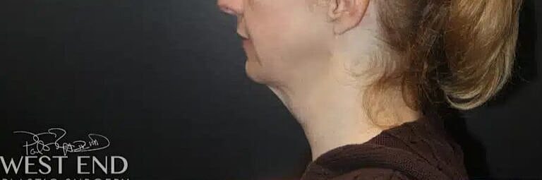 Neck Lift Before & After