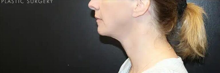 Neck Lift Before & After