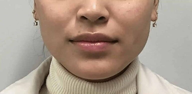 Botox Before & After