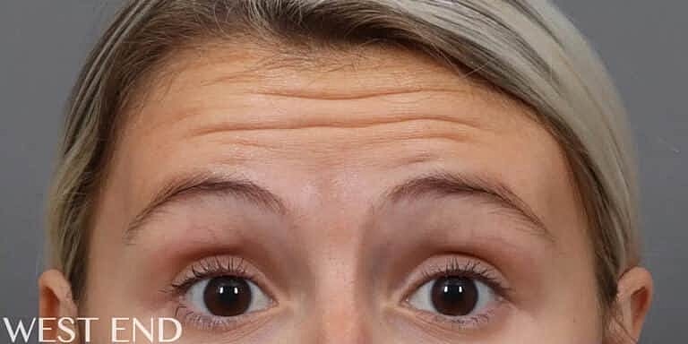 Botox Before & After