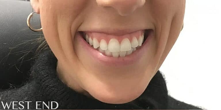 Botox Before & After