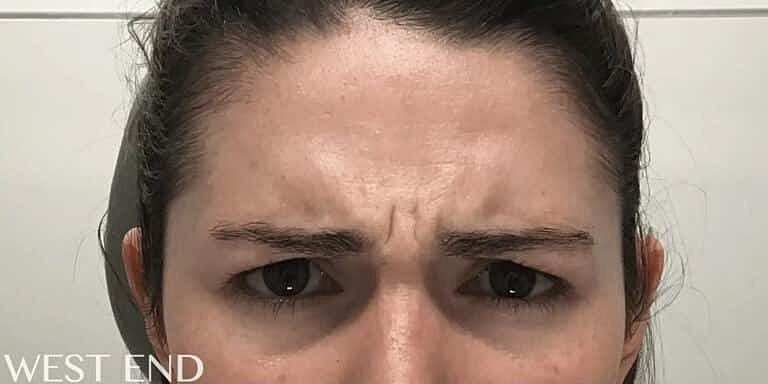 Botox Before & After