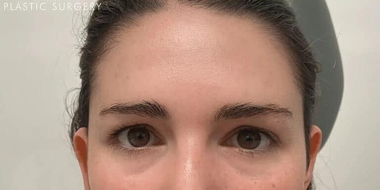 Botox Before & After