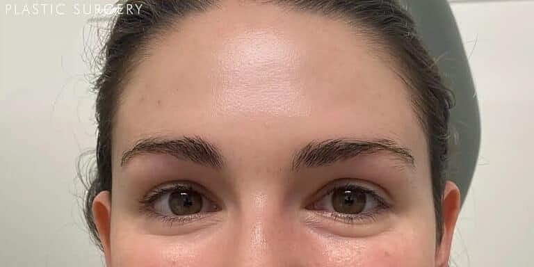 Botox Before & After