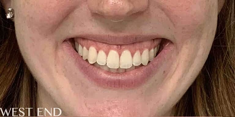 Botox Before & After