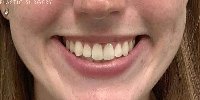 Botox Before & After