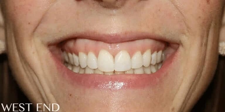 Botox Before & After